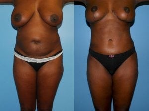 Before and After Image