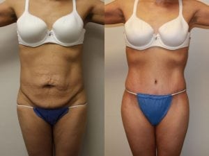 Before and After Image