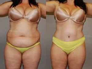 Before and After Image