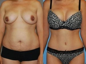 Before and After Image