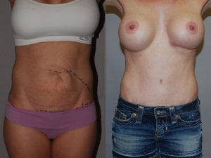 Before and After Image
