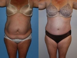 Before and After Image