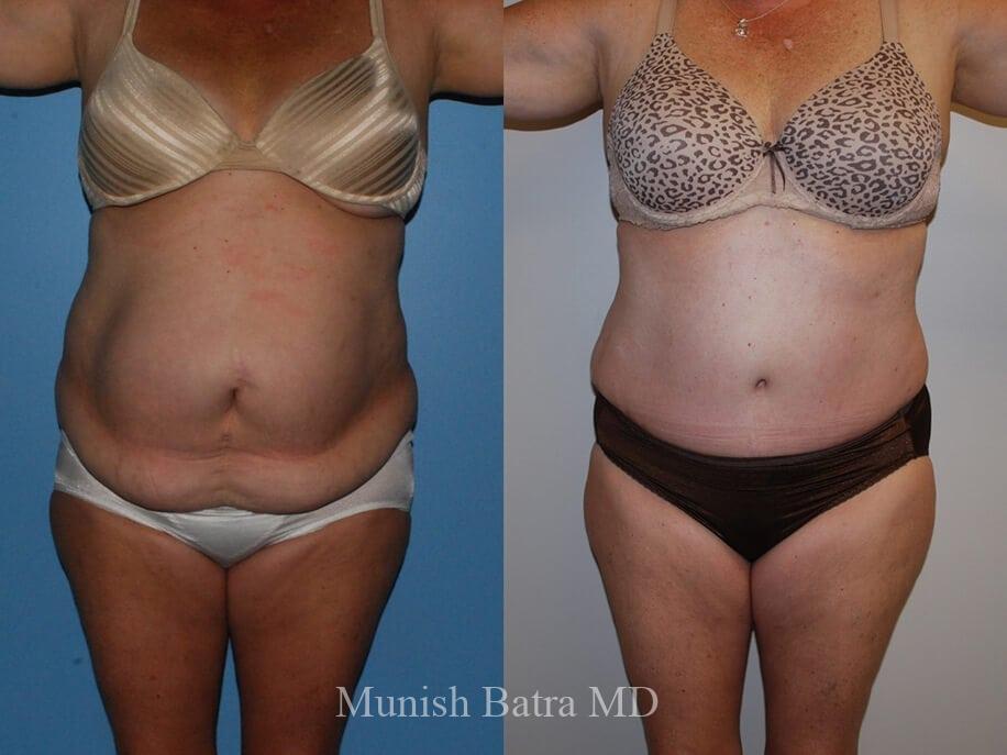 Before and After Image