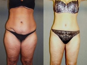 Before and After Image