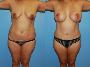 Before and After Image