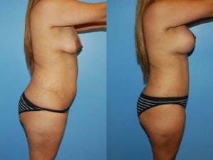 Before and After Image