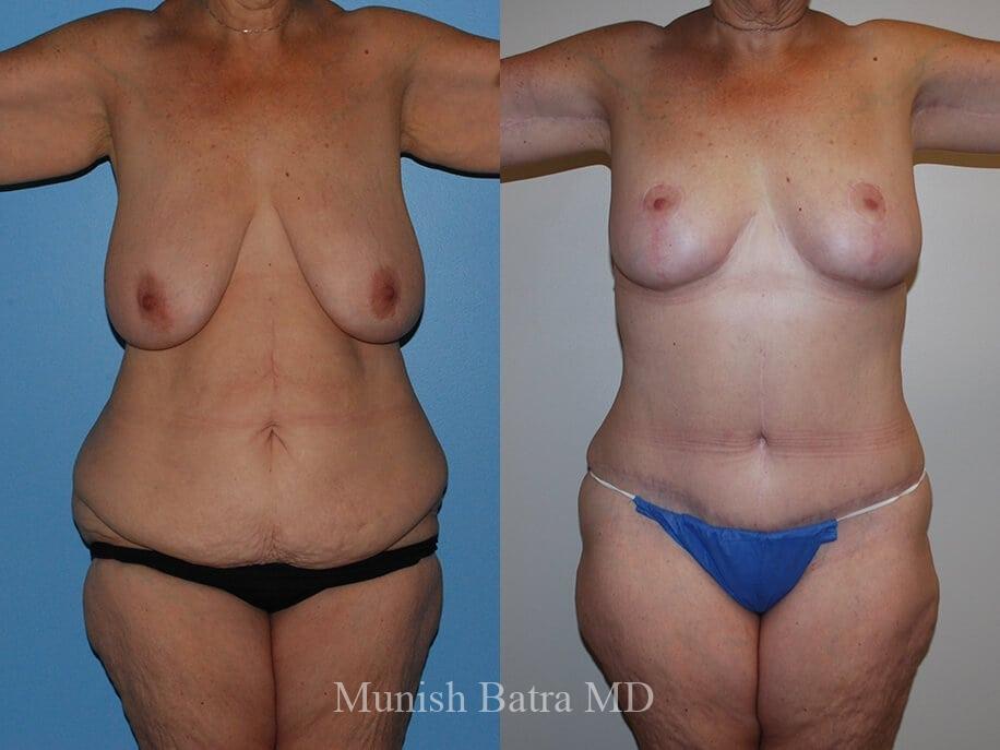 Before and After Image