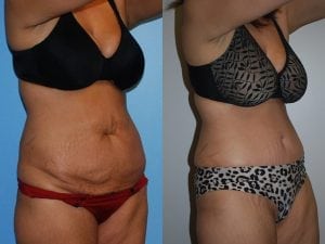 Before and After Image