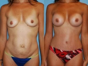 Before and After Image