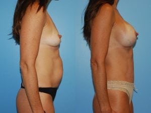Before and After Image