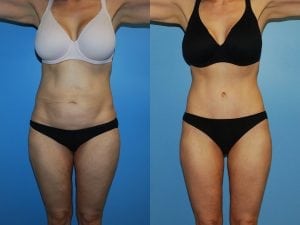 Before and After Image