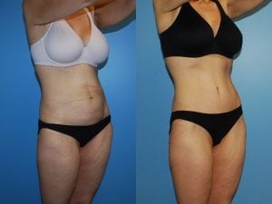 Before and After Image