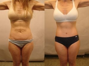 Before and After Image